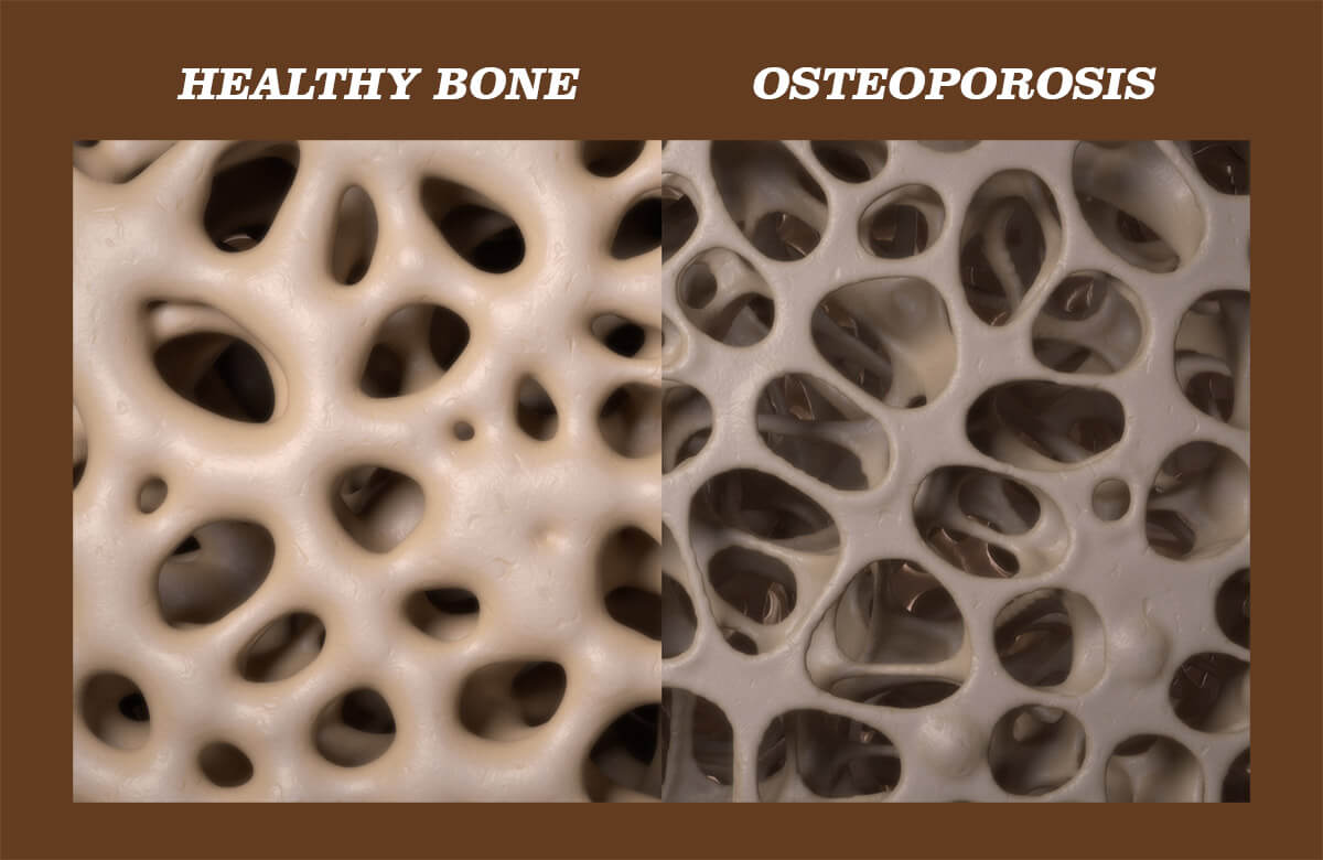 CBD for osteoporosis and bone health